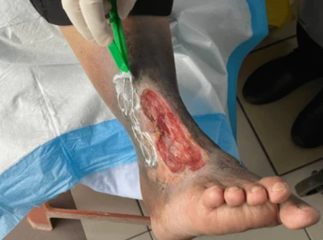 Chronic Non-Healing Wounds