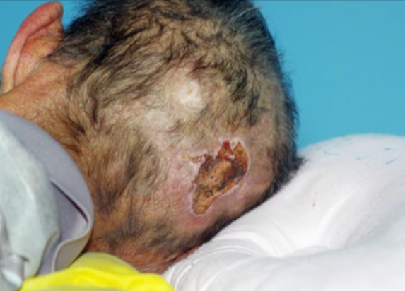 Head and scalp Ulcer