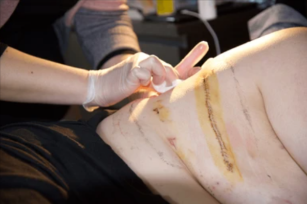 Post Surgical Wounds treatment