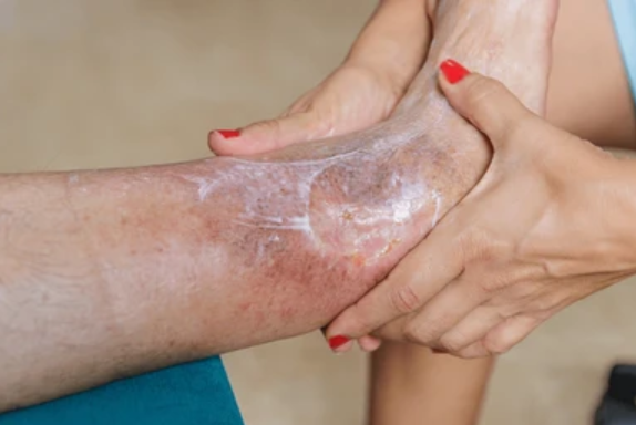 Venous Leg Ulcer